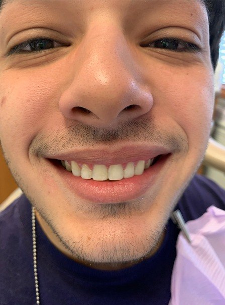 Dental patient smiling after composite dental bonding