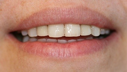 Flawless smile after replacement with dental implant supported dental crowns