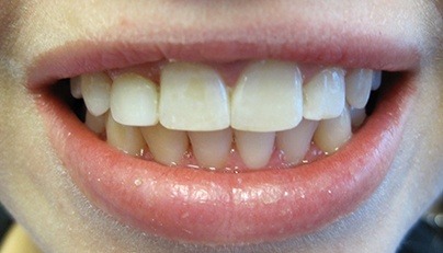 Gorgeous smile after tooth is enlarged with dental bonding