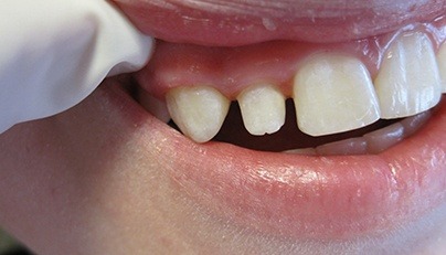 Congenitally small tooth