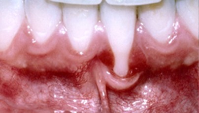 Tooth root visible due to soft tissue damage