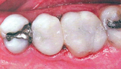 Two metal amalgam filling replaced with composite resin tooth colored fillings