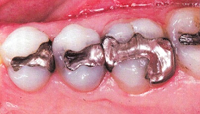 Row of teeth with large metal amalgam fillings