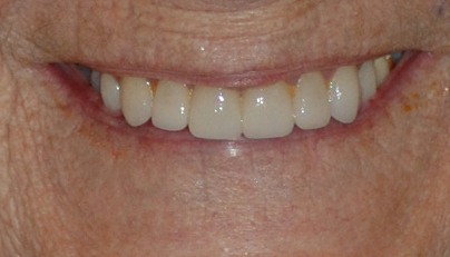 Gorgeous smile after new dental crowns and porcelain veneers are placed