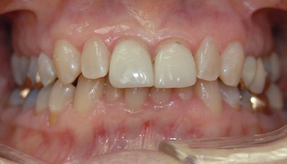Misaligned teeth and ill fitted dental crowns