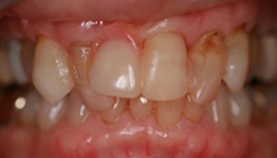 Damaged and discolored teeth