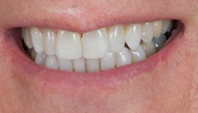 Healthy properly aligned smile after Invisalign
