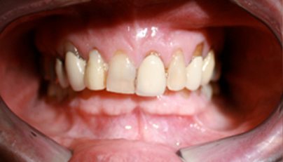 Discolored and damaged old dental crowns