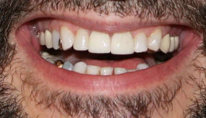 Front teeth restored with porcelain dental crowns