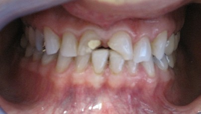 Two front teeth broken during traumatic injury