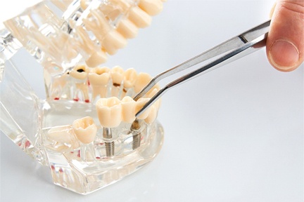 implant-retained dental bridge