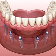 An illustration of implant dentures, which raise the cost of dentures in Evanston