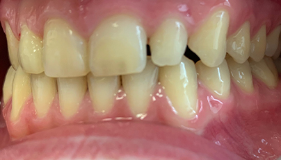Unvenly spaced teeth before Invisalign treatment