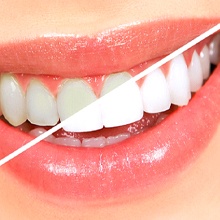 Closeup of before and after teeth whitening in Evanston