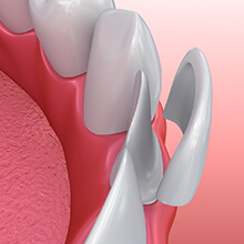 Illustration of veneer being placed on tooth