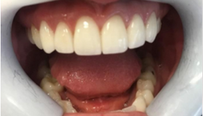 Goregous smile after cosmetic dentistry