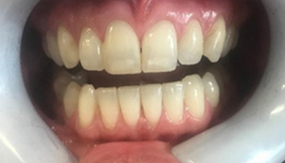 Smile with discolored and thin teeth